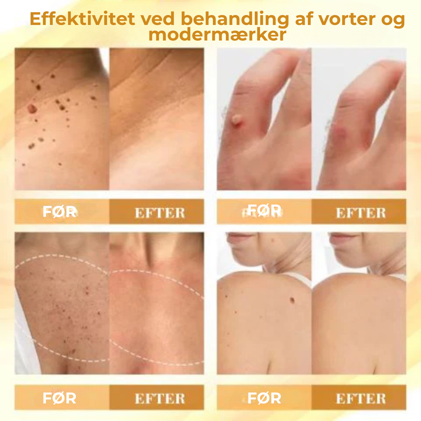 Celavie® | 48% af de adspurgte rapporterede en betydelig forbedring af udseendet af modermærker, vorter og andre hudlidelser