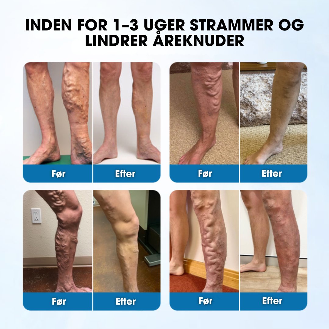 Varixal® | Synlige resultater allerede efter 48-72 timer