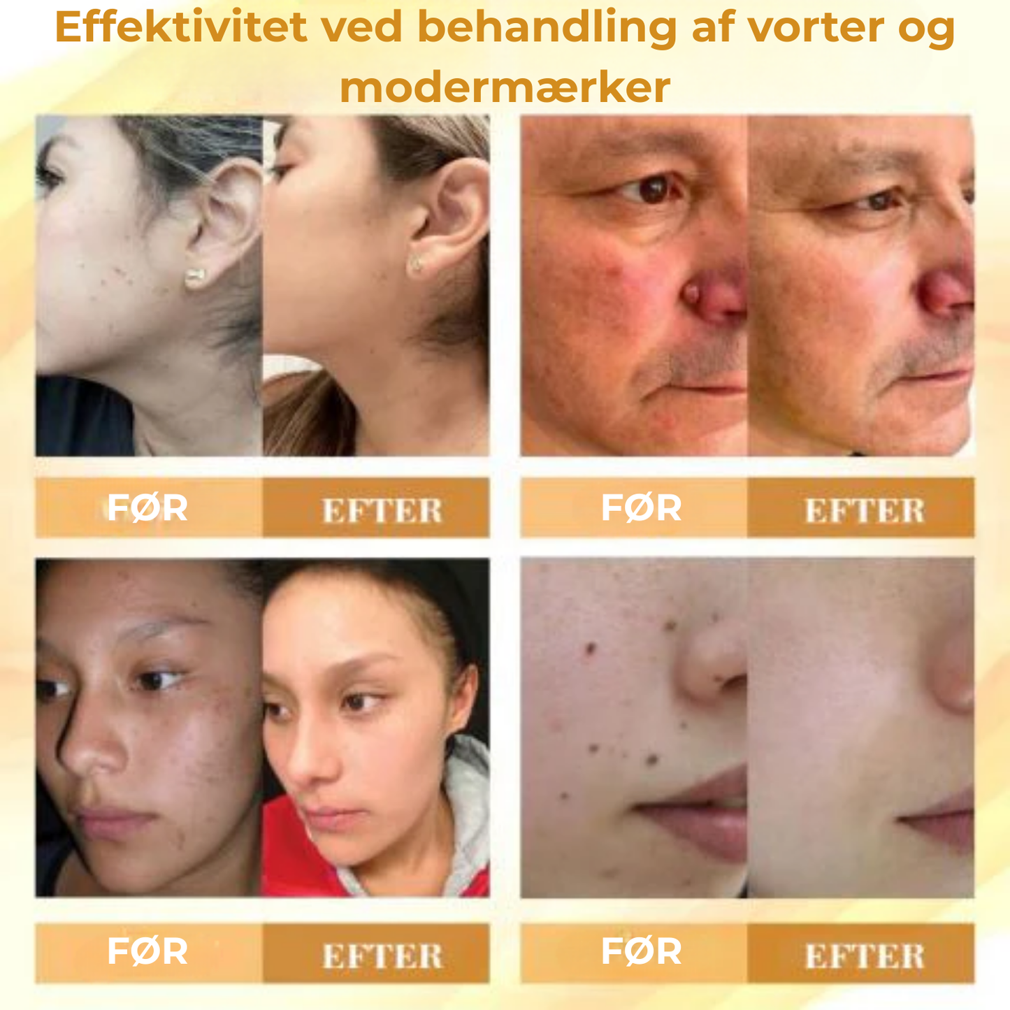 Celavie® | 48% af de adspurgte rapporterede en betydelig forbedring af udseendet af modermærker, vorter og andre hudlidelser