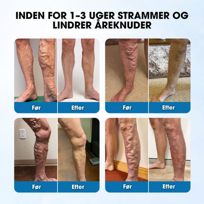 Varixal® | Synlige resultater allerede efter 48-72 timer
